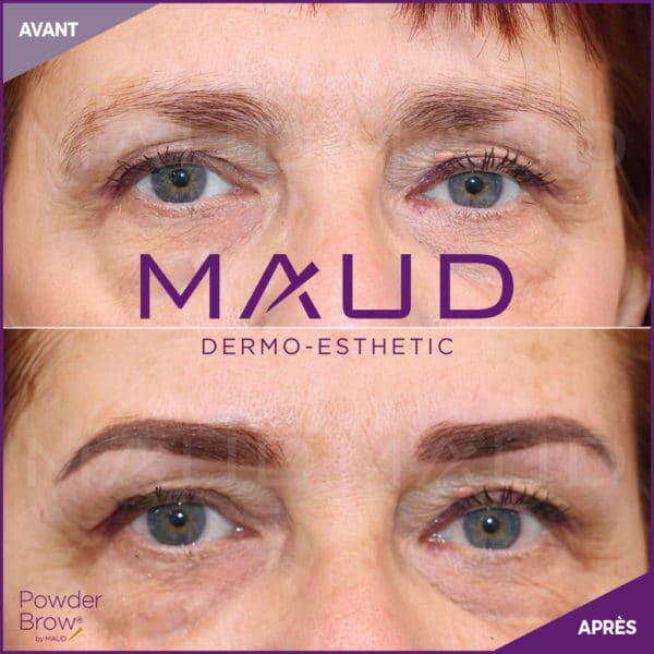 Maquillage Permanent L Vres Avant Apr S Maud Dermo Esthetic