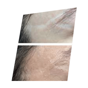 new skin needling attenuer cicatrices