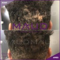 life-repair-alopecie-bounce-hair-maud-dermo-esthetic-2