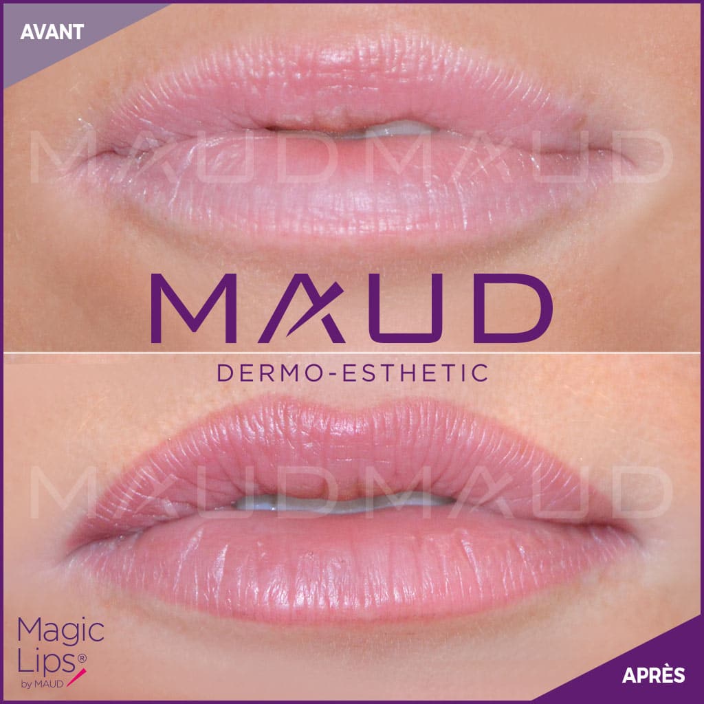 maquillage-permanent-levres-candylips-maud-dermo-esthetic-01