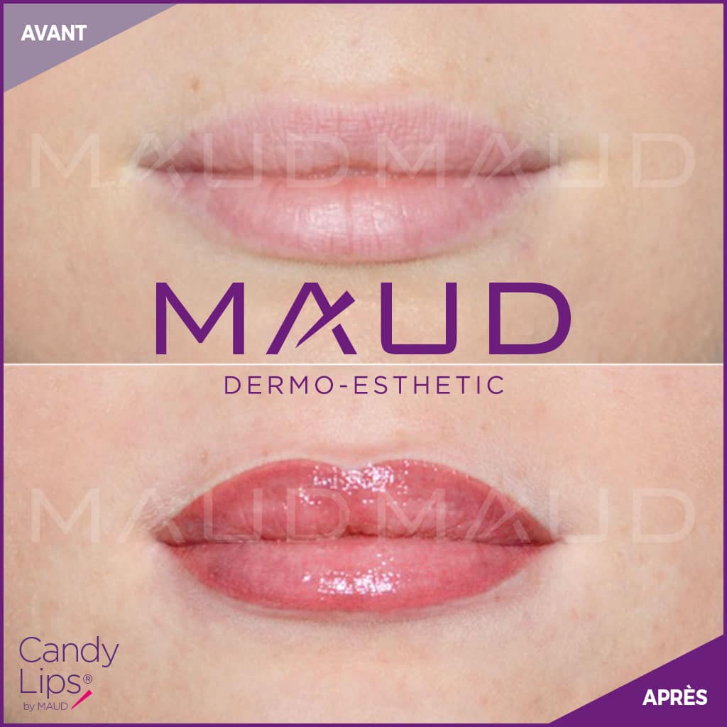maquillage-permanent-levres-candylips-maud-dermo-esthetic-02