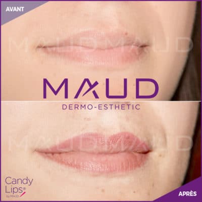maquillage-permanent-levres-candylips-maud-dermo-esthetic-03