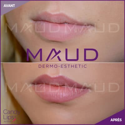 maquillage-permanent-levres-candylips-maud-dermo-esthetic-04