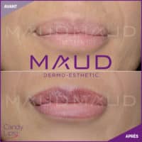 maquillage-permanent-levres-candylips-maud-dermo-esthetic-05