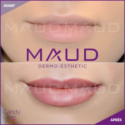 maquillage-permanent-levres-candylips-maud-dermo-esthetic-06