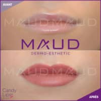 maquillage-permanent-levres-candylips-maud-dermo-esthetic-07