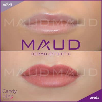 maquillage-permanent-levres-candylips-maud-dermo-esthetic-07