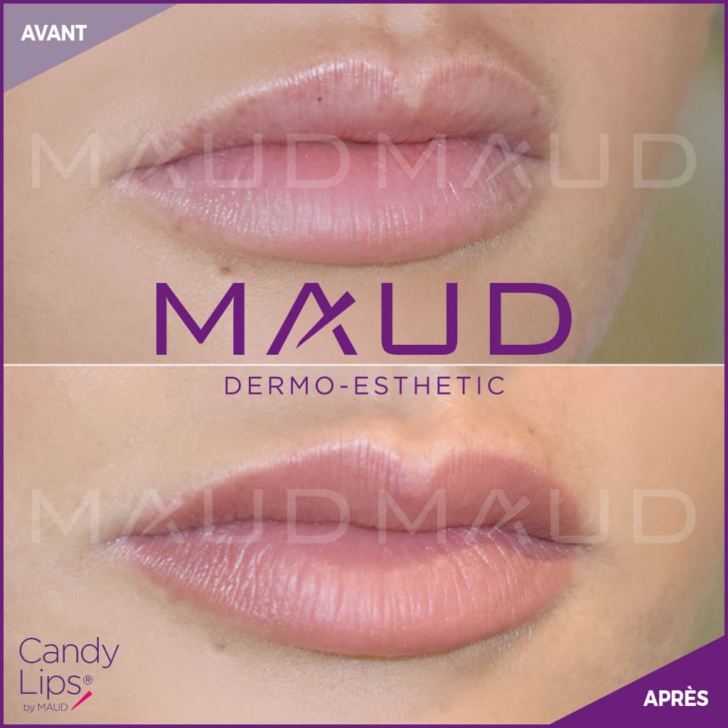maquillage-permanent-levres-candylips-maud-dermo-esthetic-08