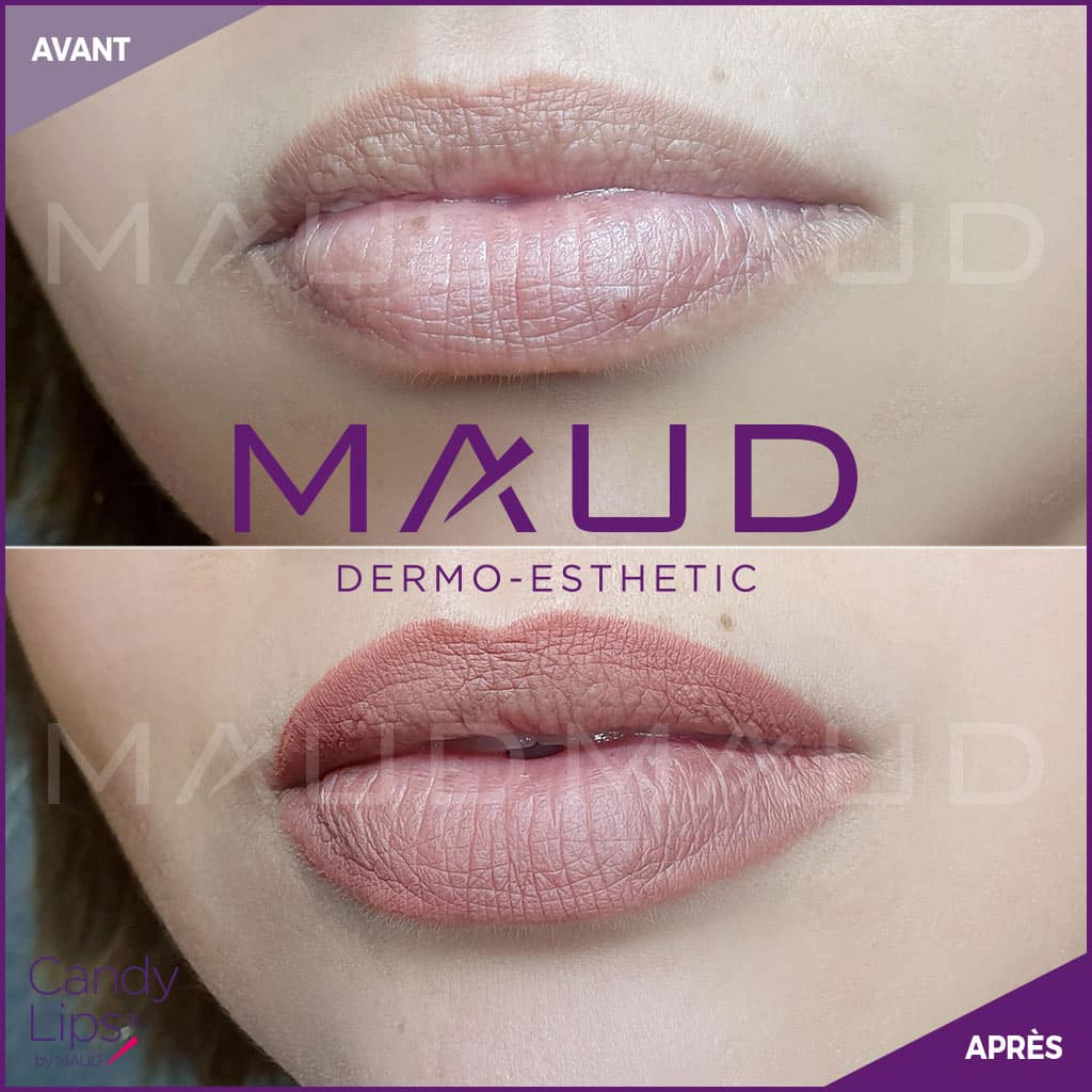 maquillage-permanent-levres-candylips-maud-dermo-esthetic-09
