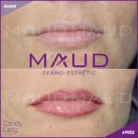 maquillage-permanent-levres-candylips-maud-dermo-esthetic-10