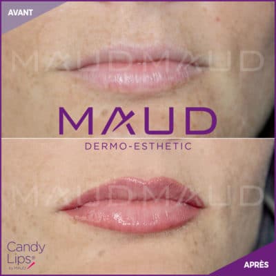 maquillage-permanent-levres-candylips-maud-dermo-esthetic-10