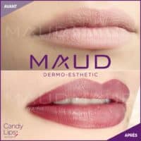 maquillage-permanent-levres-candylips-maud-dermo-esthetic-11 (1)