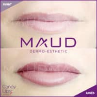 maquillage-permanent-levres-candylips-maud-dermo-esthetic-12