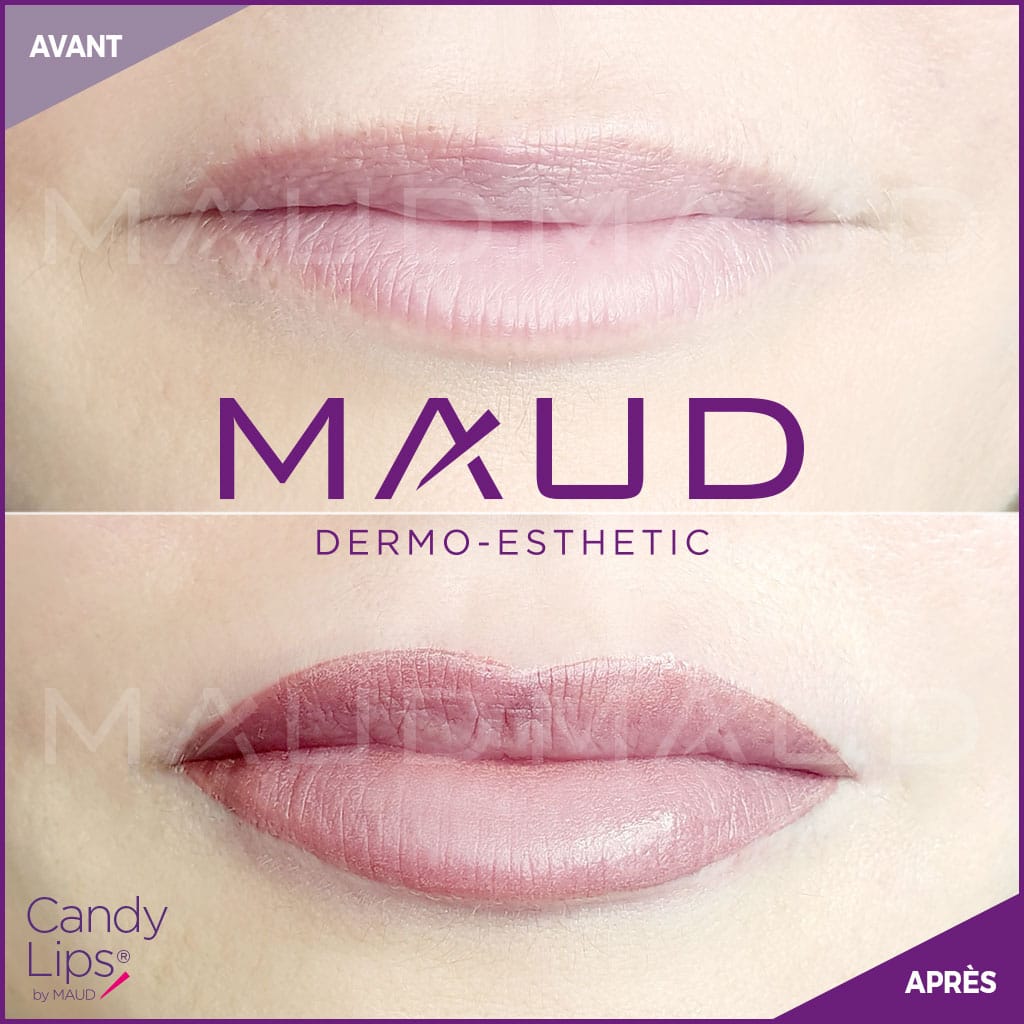 maquillage-permanent-levres-candylips-maud-dermo-esthetic-12