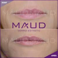 maquillage-permanent-levres-fresh-lips-maud-dermo-esthetic-05