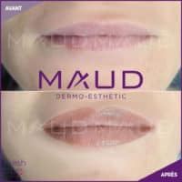maquillage-permanent-levres-fresh-lips-maud-dermo-esthetic-06