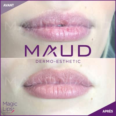 maquillage-permanent-levres-magiclips-maud-dermo-esthetic-03