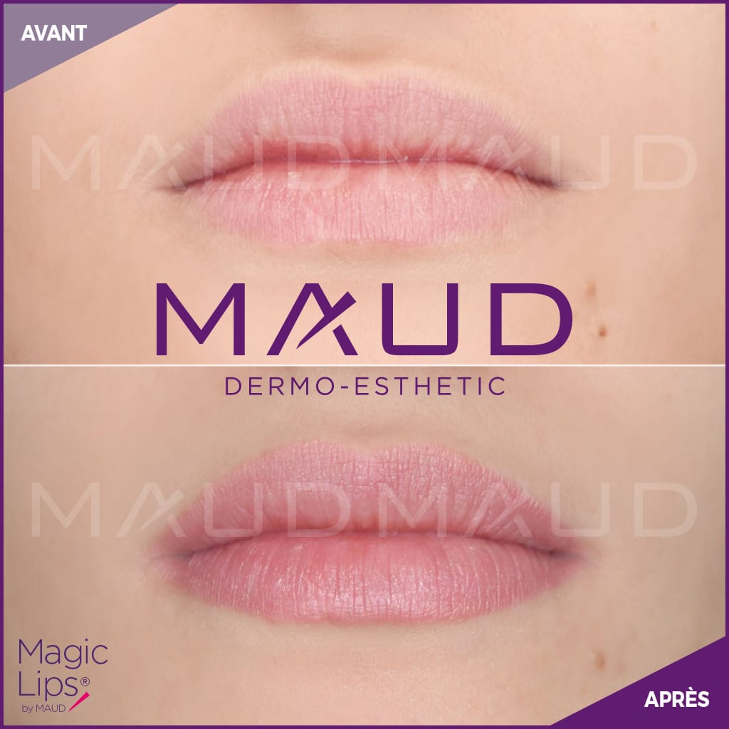 maquillage-permanent-levres-magiclips-maud-dermo-esthetic-08