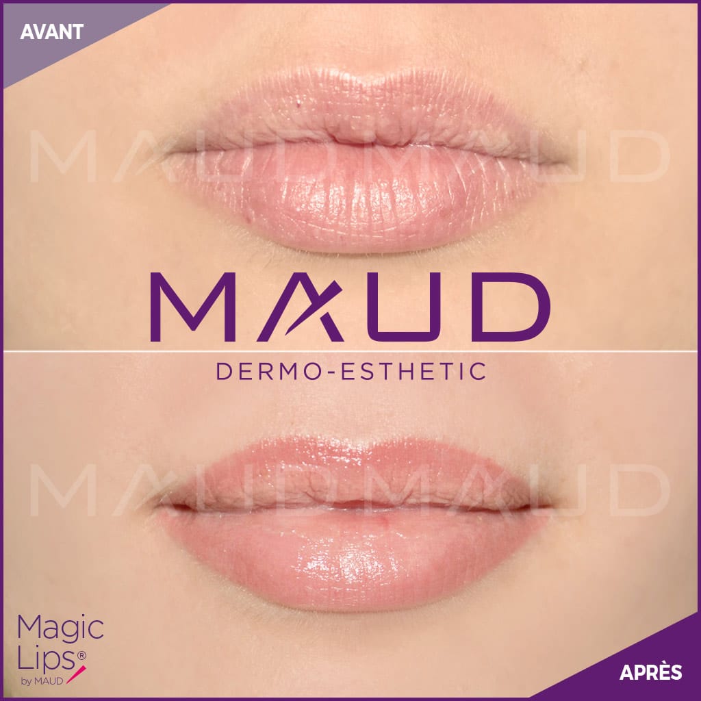 maquillage-permanent-levres-magiclips-maud-dermo-esthetic-10 (1)