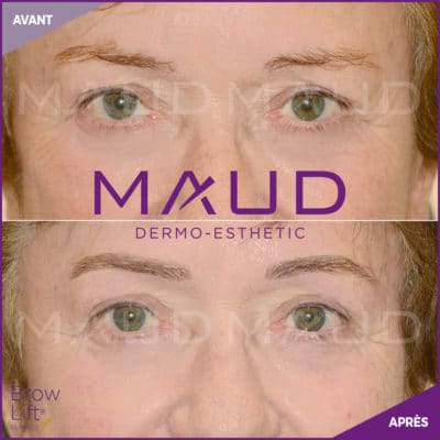maquillage-permanent-sourcils-brow-lift-maud-dermo-esthetic-03 (1)