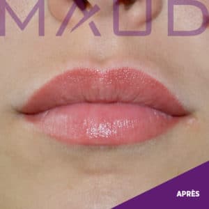 Après